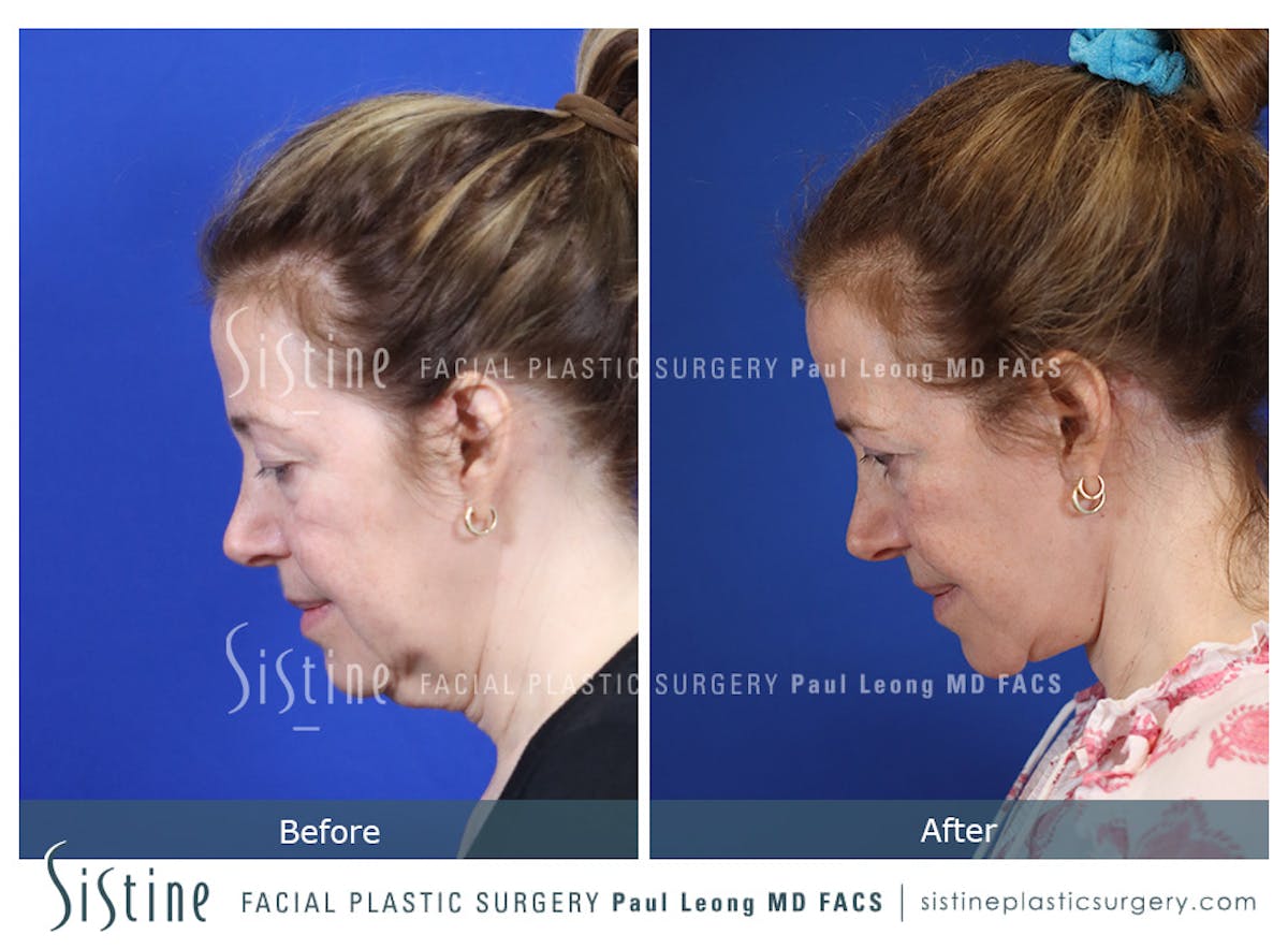 Blepharoplasty Before & After Gallery - Patient 214423 - Image 8