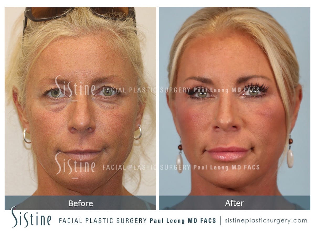 Facelift Before & After Gallery - Patient 146720 - Image 1
