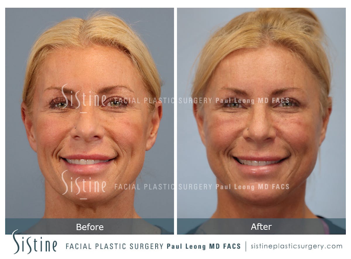 Facelift Before & After Gallery - Patient 146720 - Image 2