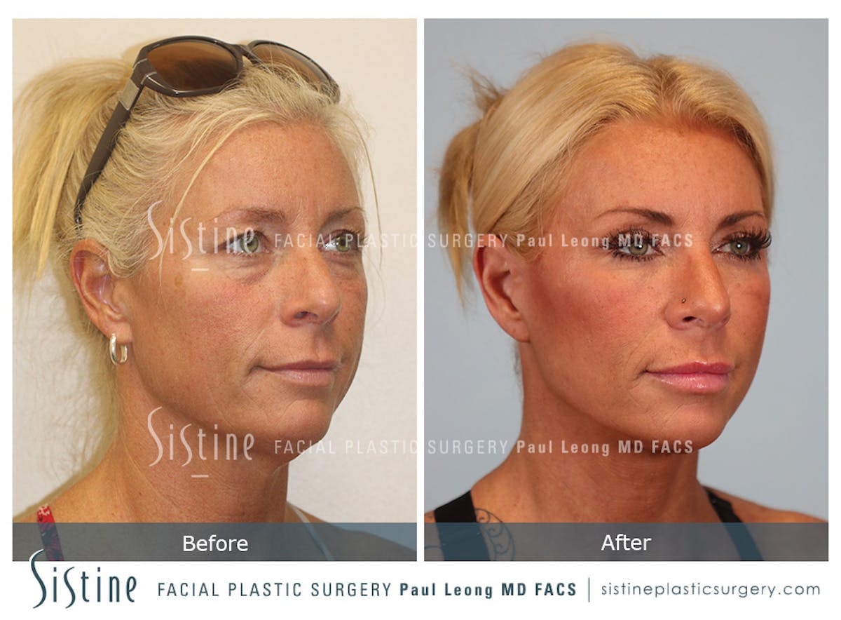 Facelift Before & After Gallery - Patient 146720 - Image 3