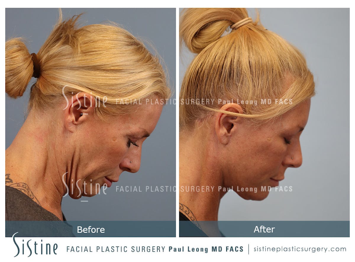 Facelift Before & After Gallery - Patient 146720 - Image 5