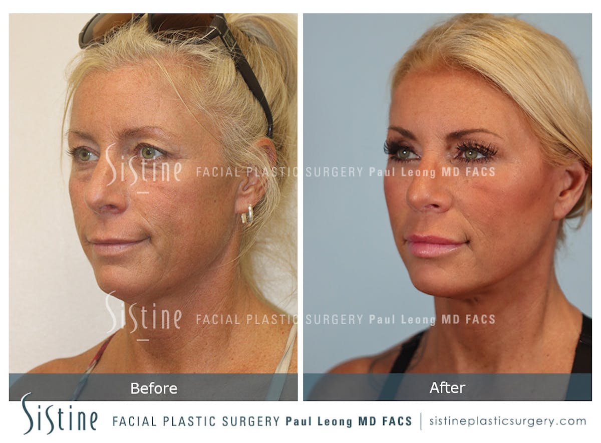 Facelift Before & After Gallery - Patient 146720 - Image 6