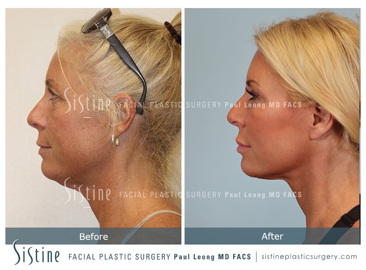 Facelift Before & After Gallery - Patient 146720 - Image 7
