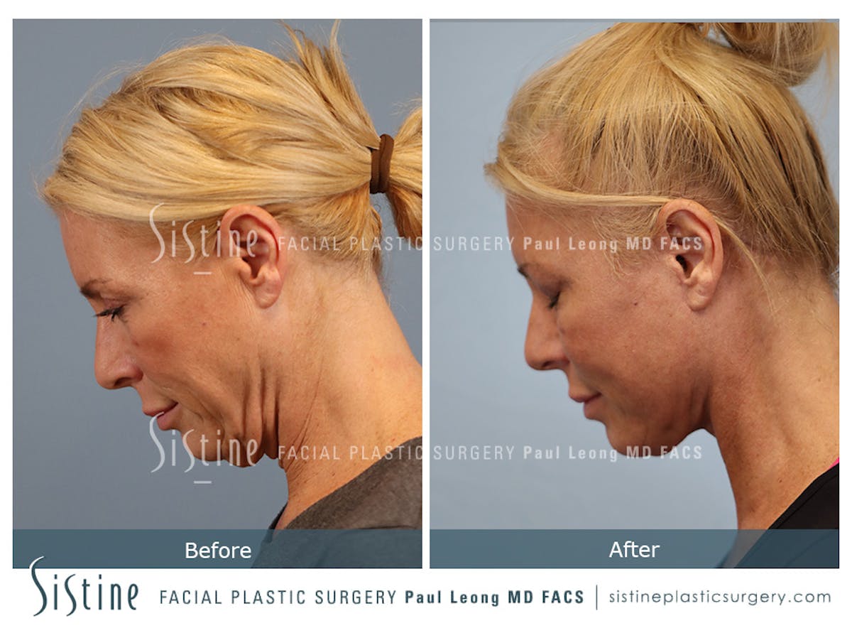 Facelift Before & After Gallery - Patient 146720 - Image 8