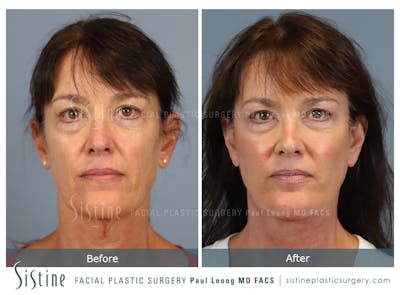 Facelift Before & After Gallery - Patient 197168 - Image 1