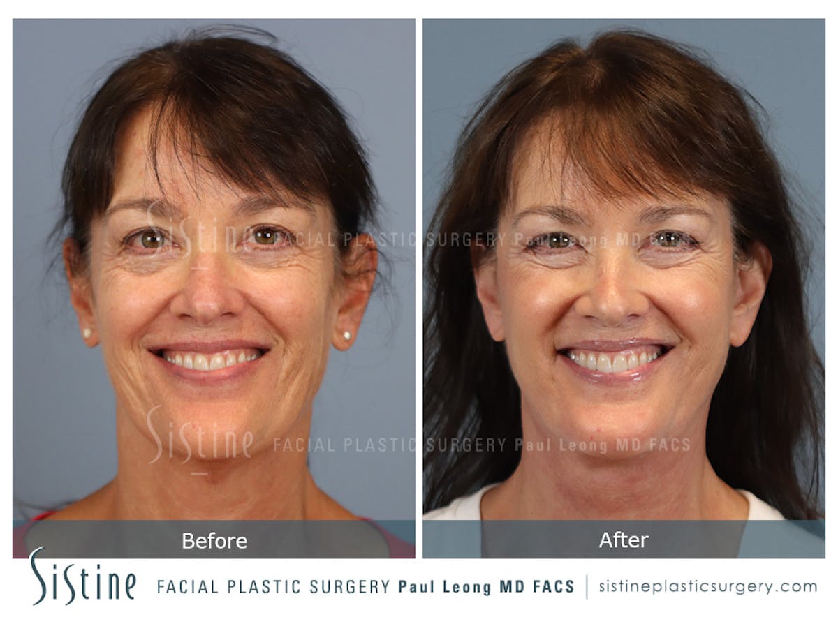 Facelift Before & After Gallery - Patient 197168 - Image 2