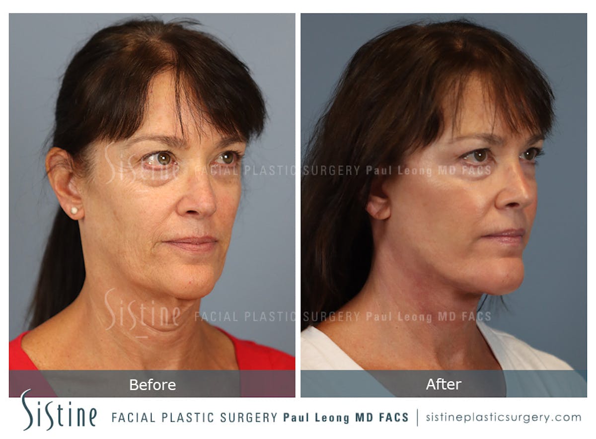 Facelift Before & After Gallery - Patient 197168 - Image 3