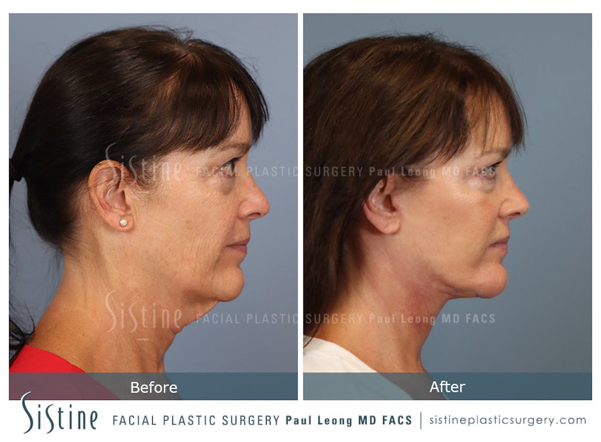 Facelift Before & After Gallery - Patient 197168 - Image 4