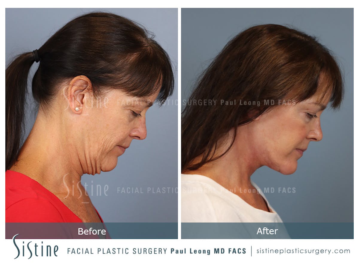 Facelift Before & After Gallery - Patient 197168 - Image 5