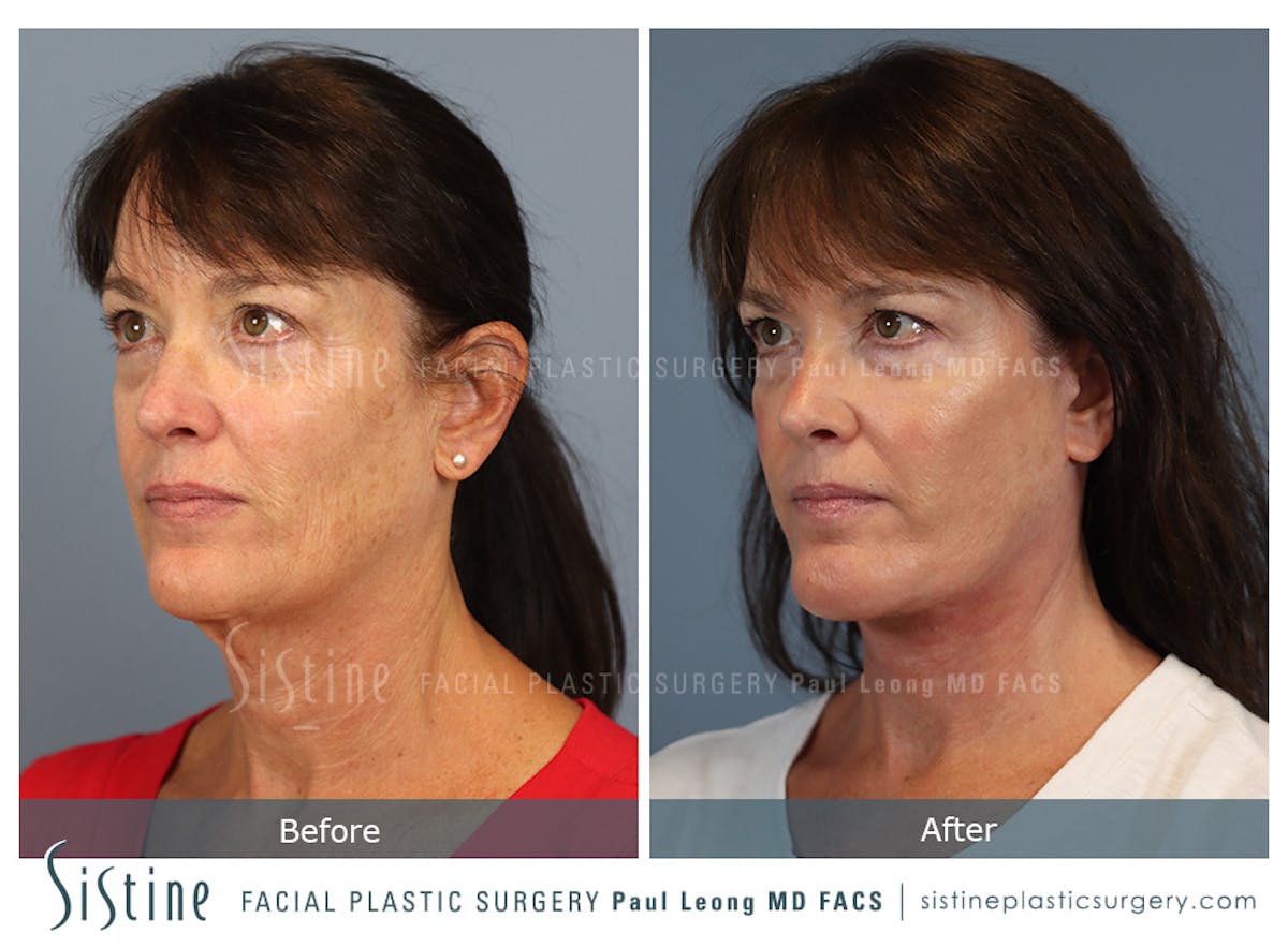 Facelift Before & After Gallery - Patient 197168 - Image 6