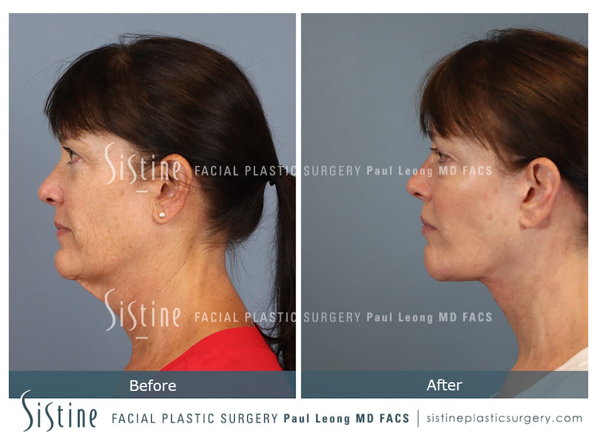 Facelift Before & After Gallery - Patient 197168 - Image 7