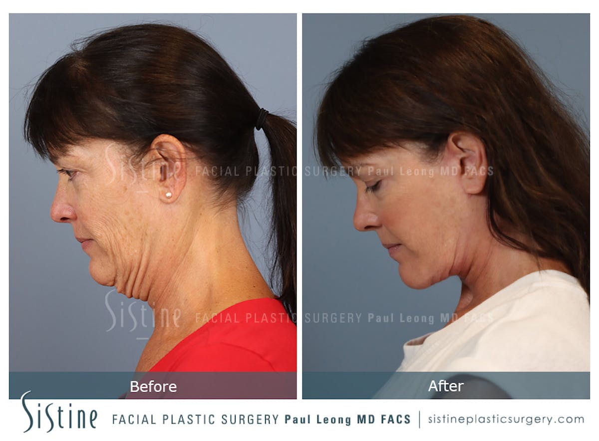 Facelift Before & After Gallery - Patient 197168 - Image 8