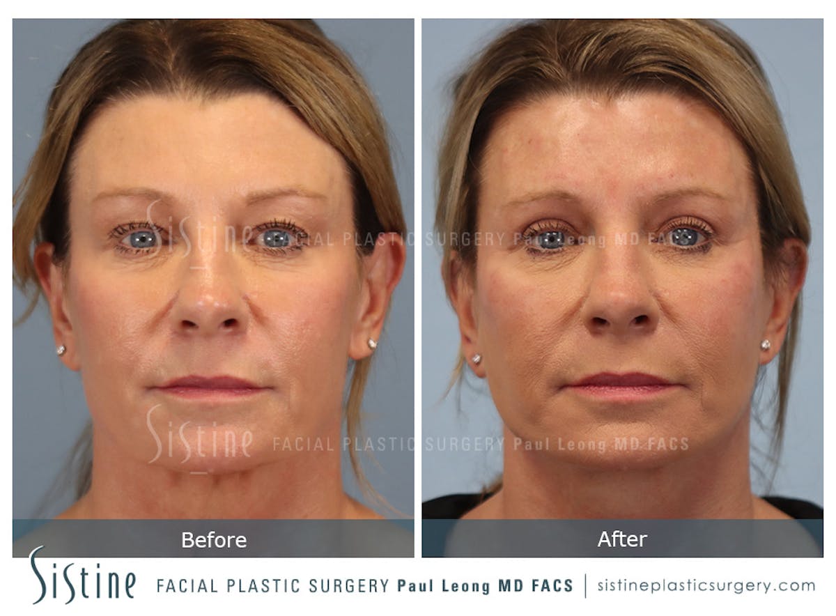 Blepharoplasty Before & After Gallery - Patient 258313 - Image 1