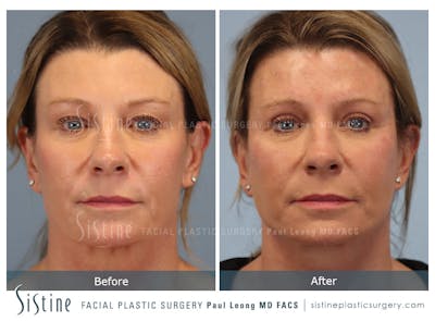 Facelift Before & After Gallery - Patient 105448 - Image 1