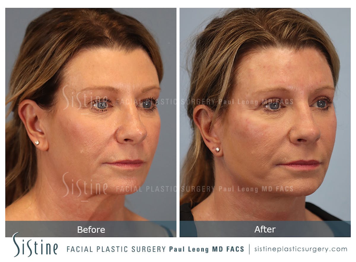 Blepharoplasty Before & After Gallery - Patient 258313 - Image 2