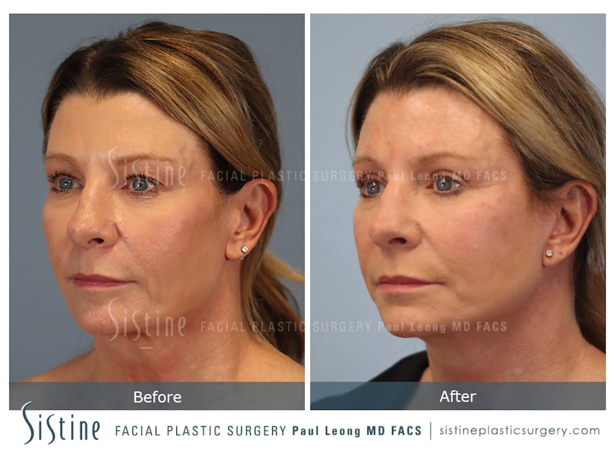 Blepharoplasty Before & After Gallery - Patient 258313 - Image 4