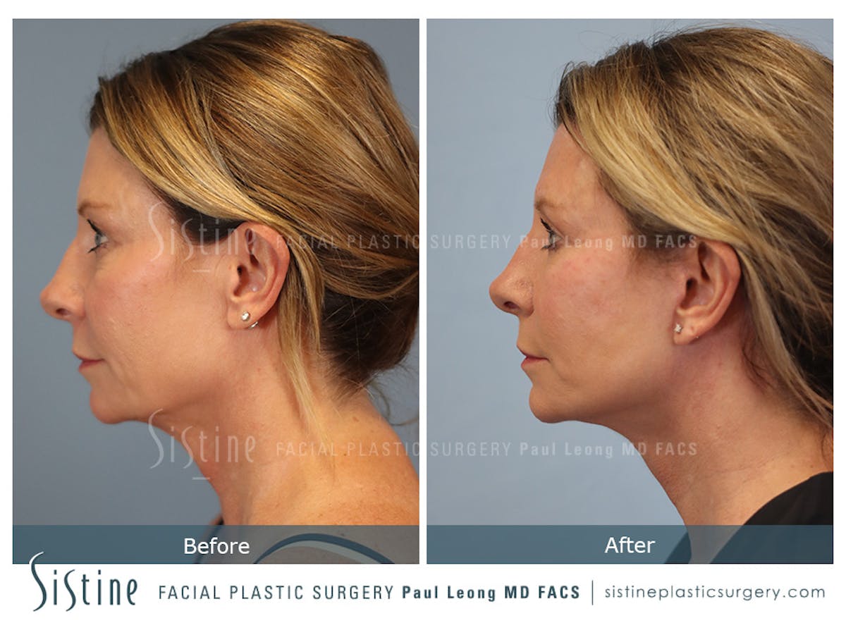 Blepharoplasty Before & After Gallery - Patient 258313 - Image 5