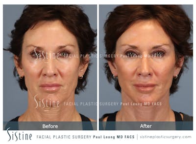 Facelift Before & After Gallery - Patient 304942 - Image 1