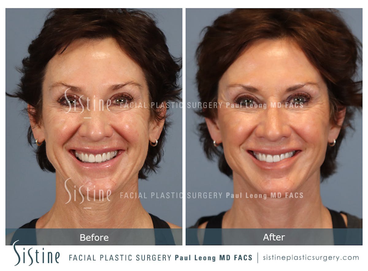 Facelift Before & After Gallery - Patient 304942 - Image 2