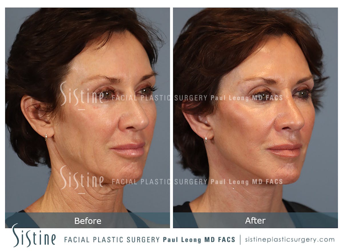 Facelift Before & After Gallery - Patient 304942 - Image 3