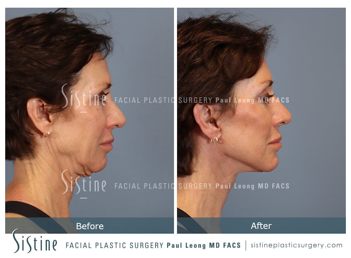 Facelift Before & After Gallery - Patient 304942 - Image 4