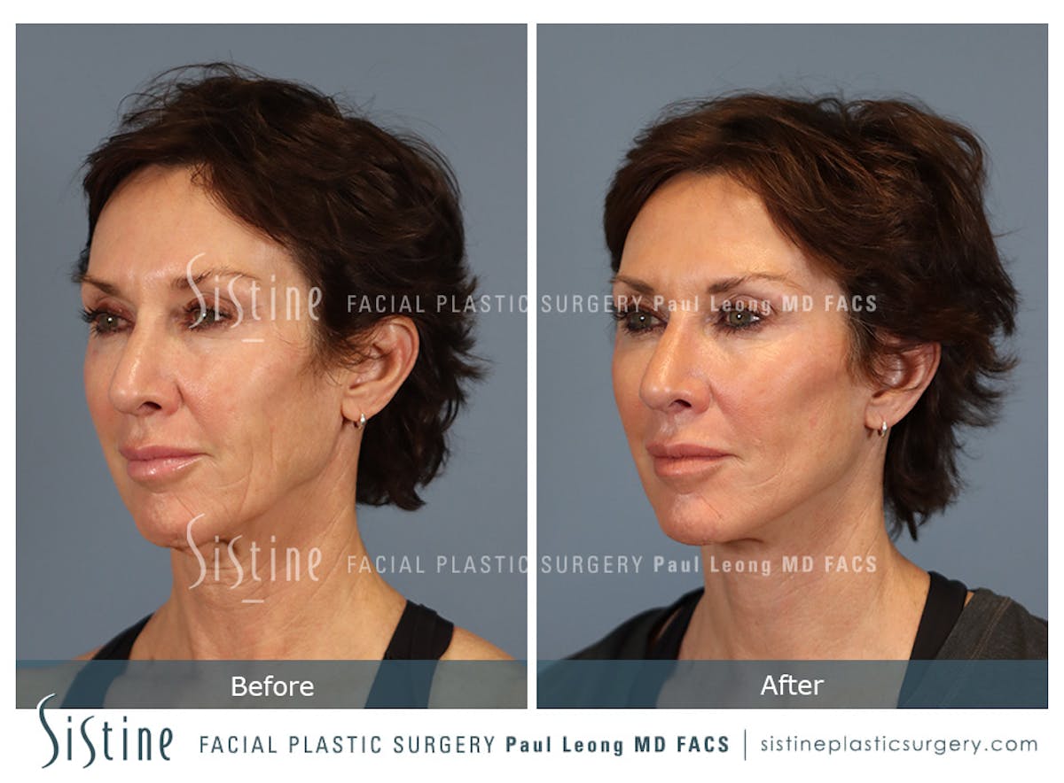 Facelift Before & After Gallery - Patient 304942 - Image 5
