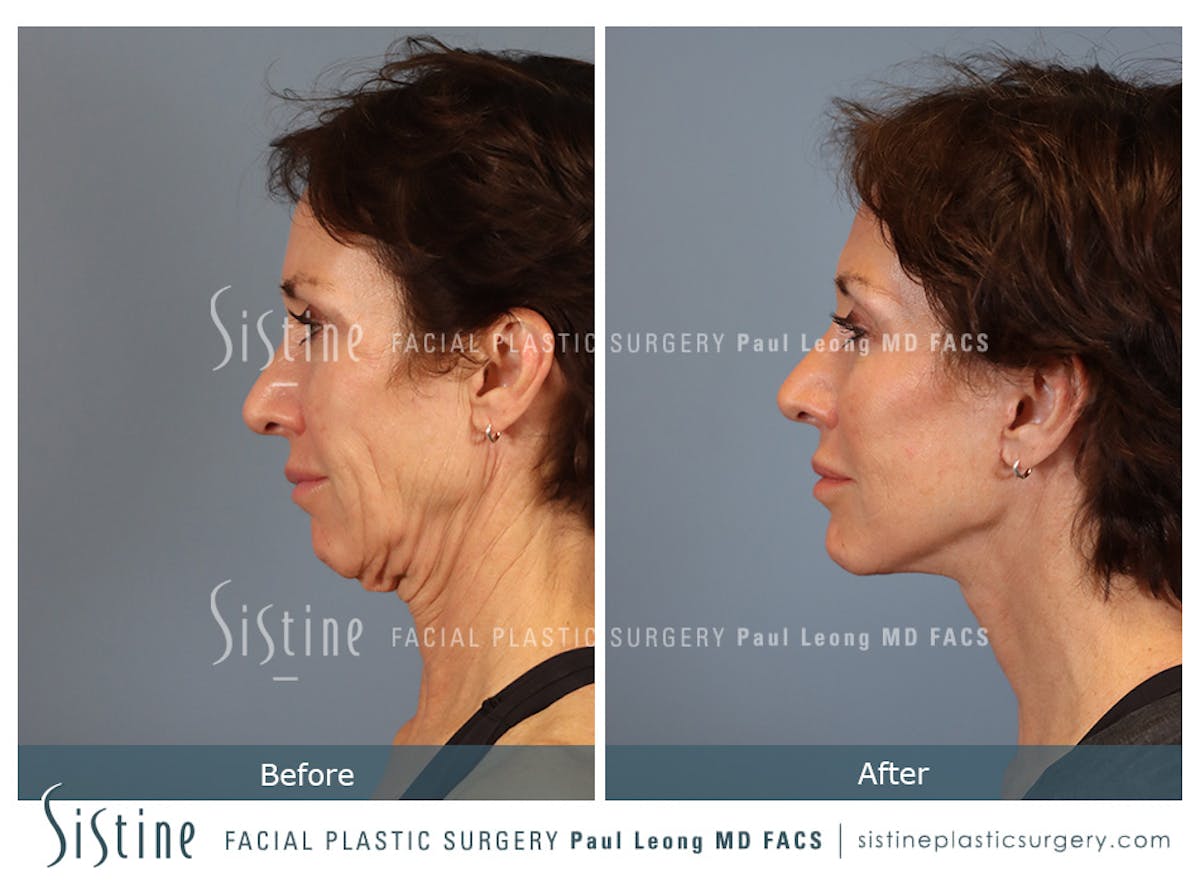 Facelift Before & After Gallery - Patient 304942 - Image 6