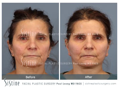 Facelift Before & After Gallery - Patient 175155 - Image 1