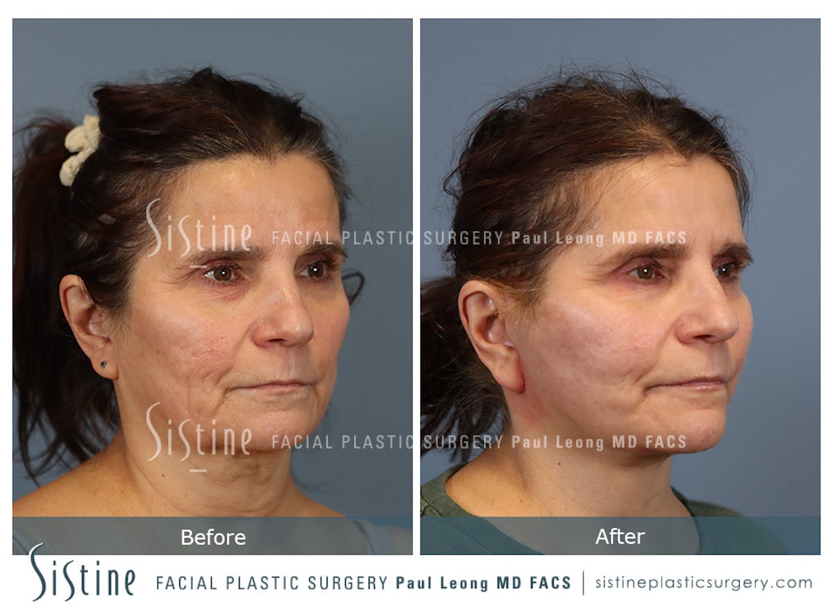 Facelift Before & After Gallery - Patient 175155 - Image 2