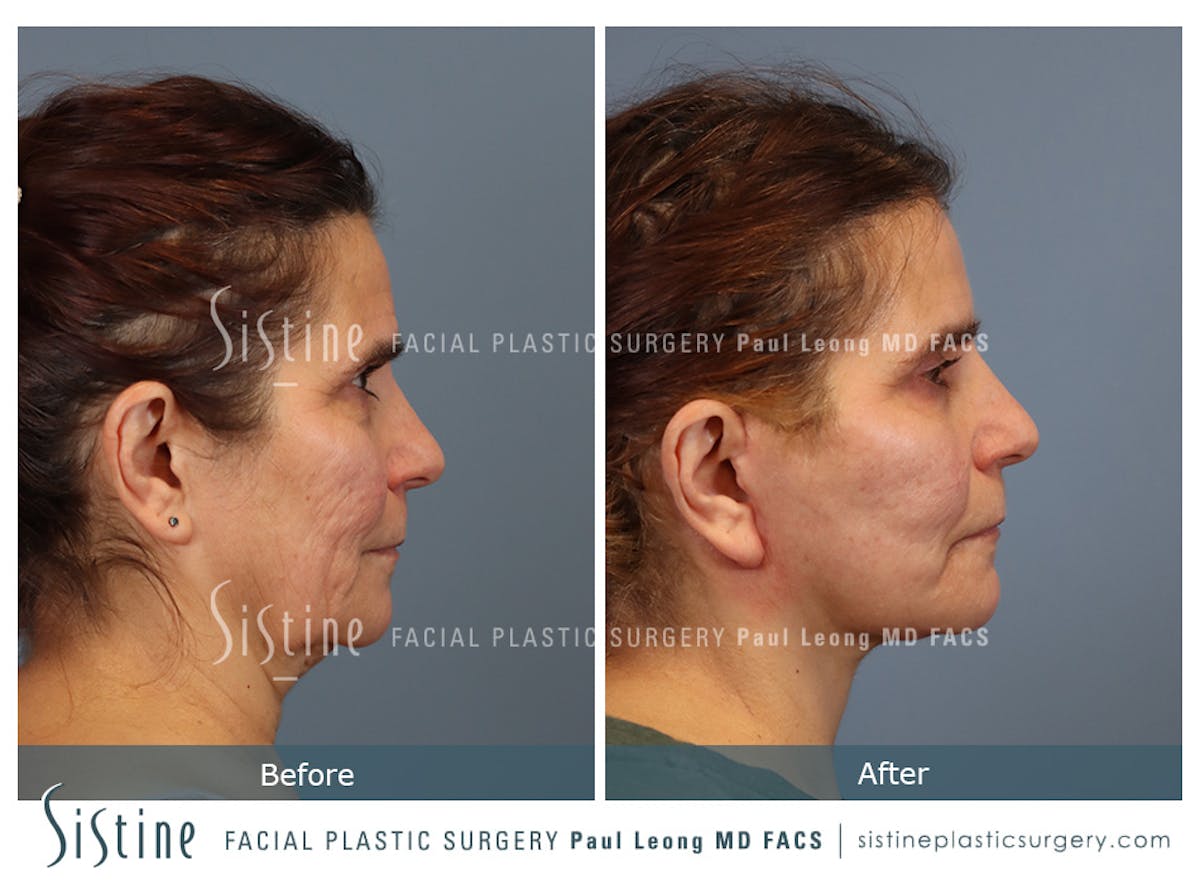 Facelift Before & After Gallery - Patient 175155 - Image 3
