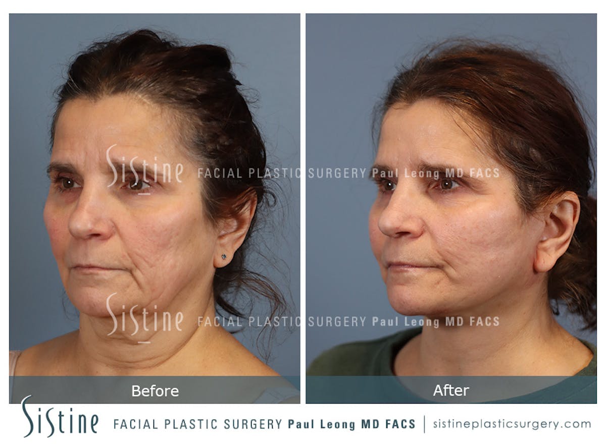 Facelift Before & After Gallery - Patient 175155 - Image 5