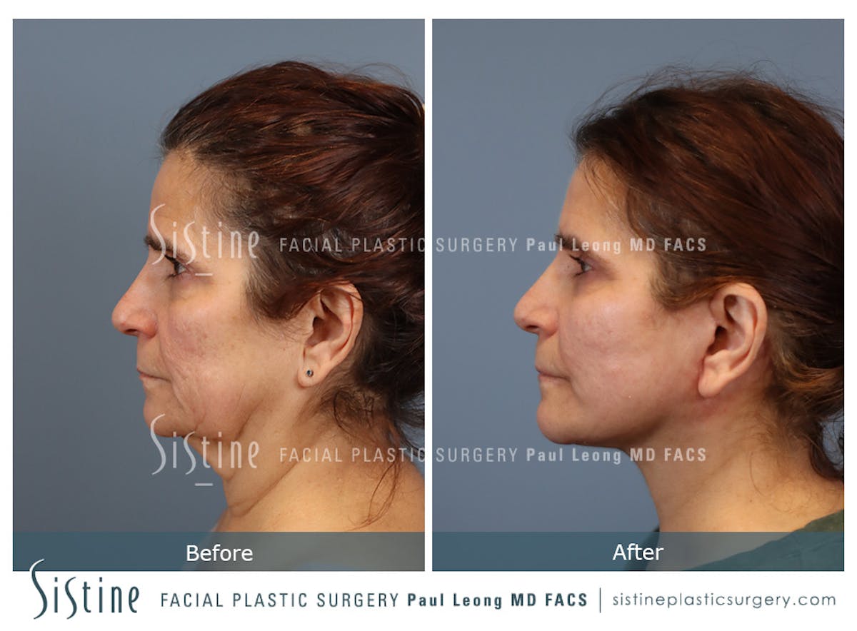 Facelift Before & After Gallery - Patient 175155 - Image 6