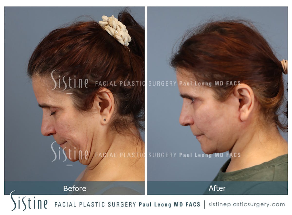 Facelift Before & After Gallery - Patient 175155 - Image 7