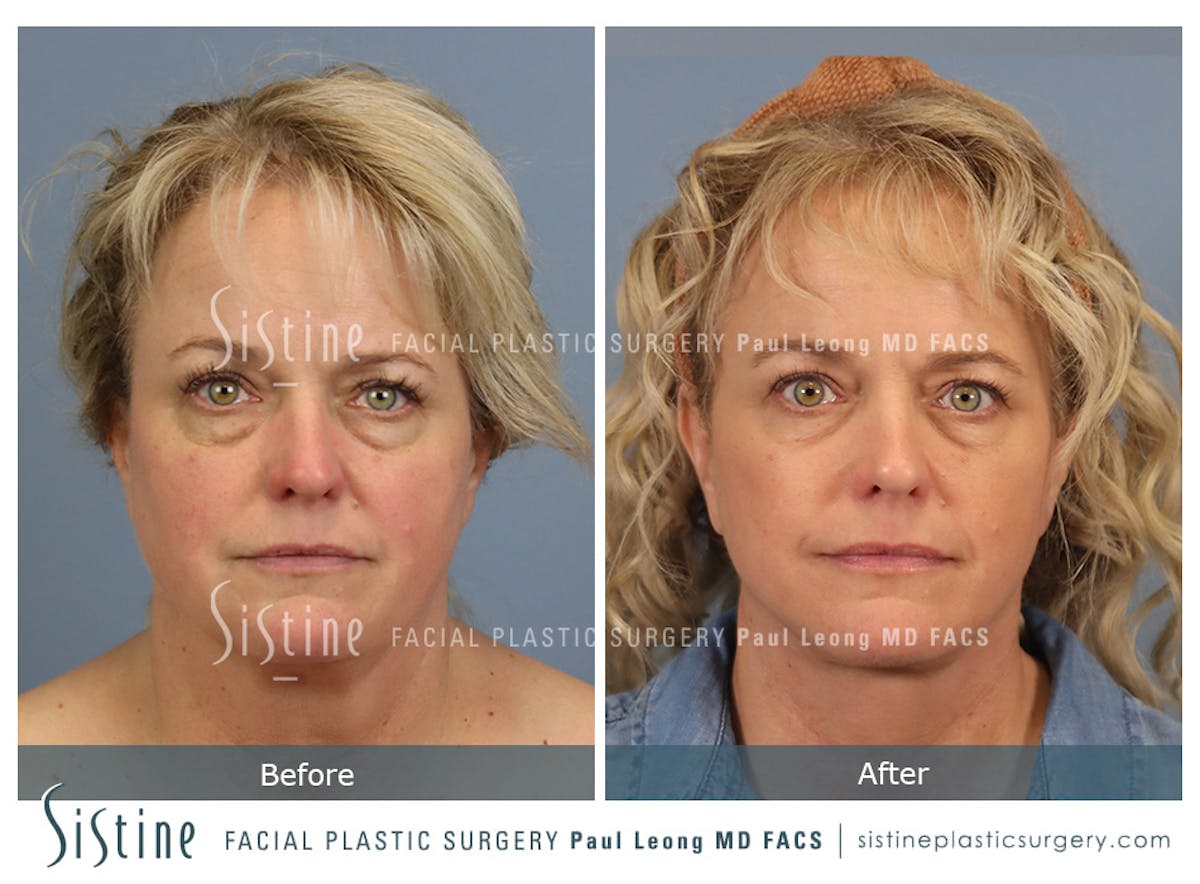 Facelift Before & After Gallery - Patient 302623 - Image 1