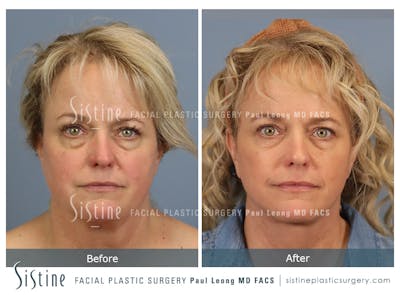 Facelift Before & After Gallery - Patient 302623 - Image 1