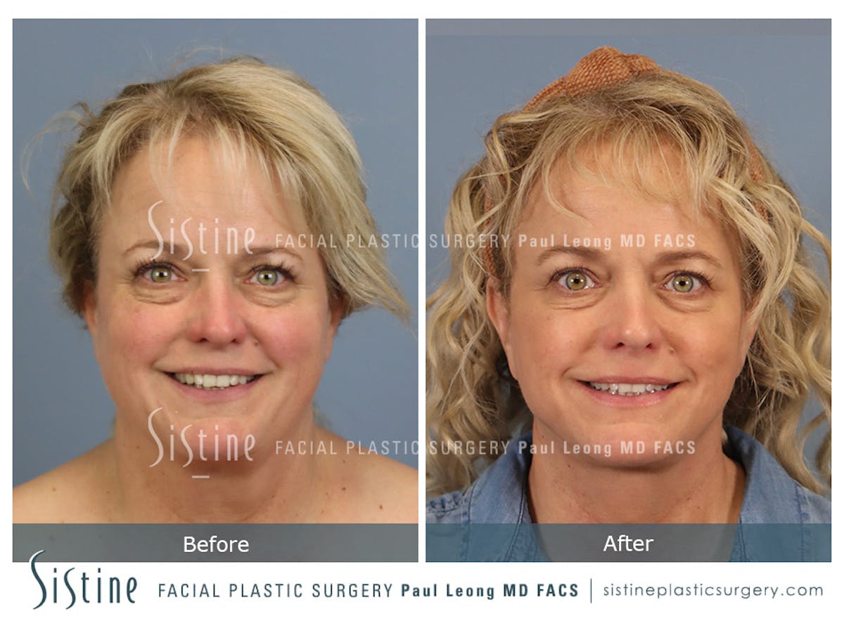 Facelift Before & After Gallery - Patient 302623 - Image 2