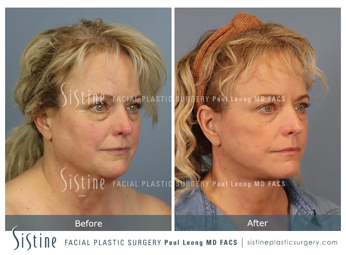 Facelift Before & After Gallery - Patient 302623 - Image 3