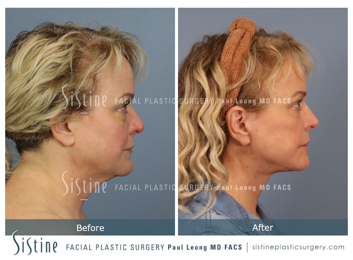 Facelift Before & After Gallery - Patient 302623 - Image 4