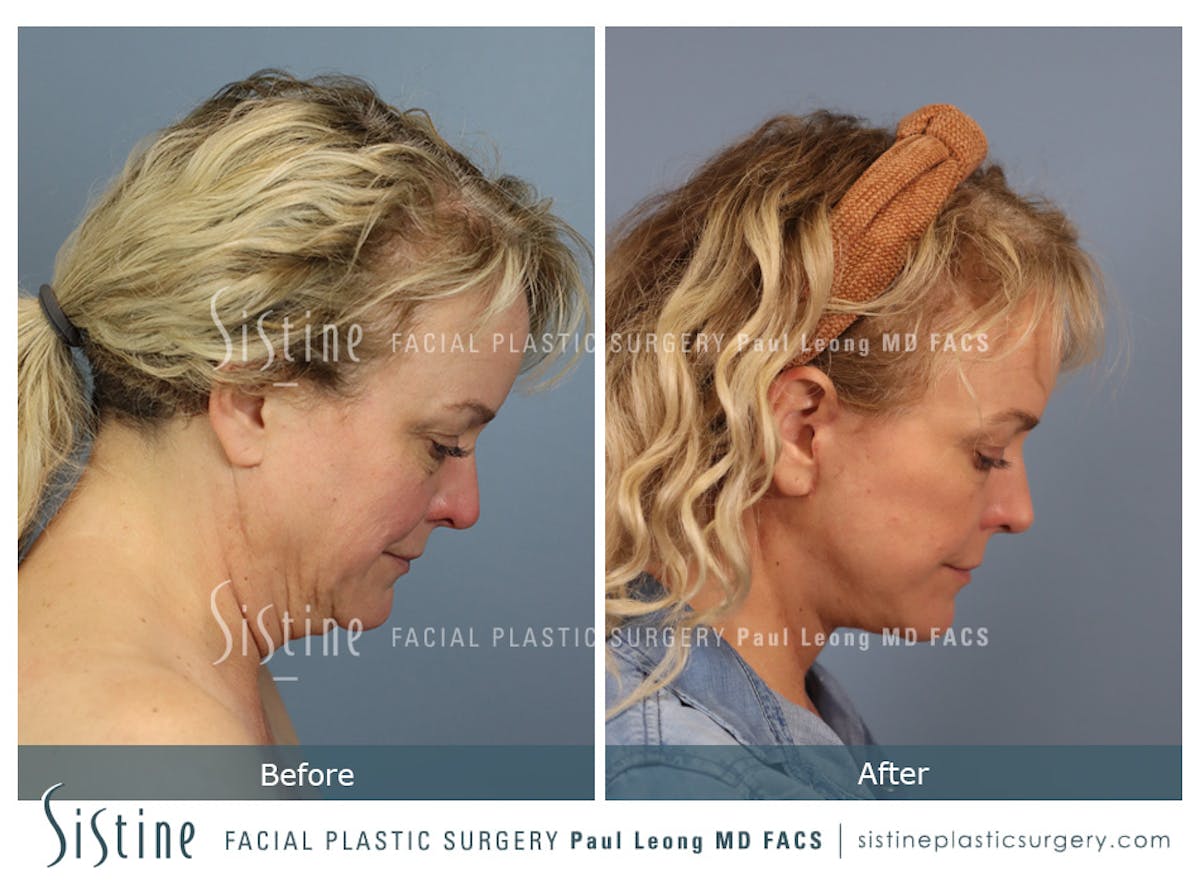 Facelift Before & After Gallery - Patient 302623 - Image 5