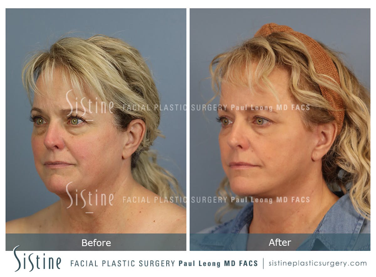 Facelift Before & After Gallery - Patient 302623 - Image 6