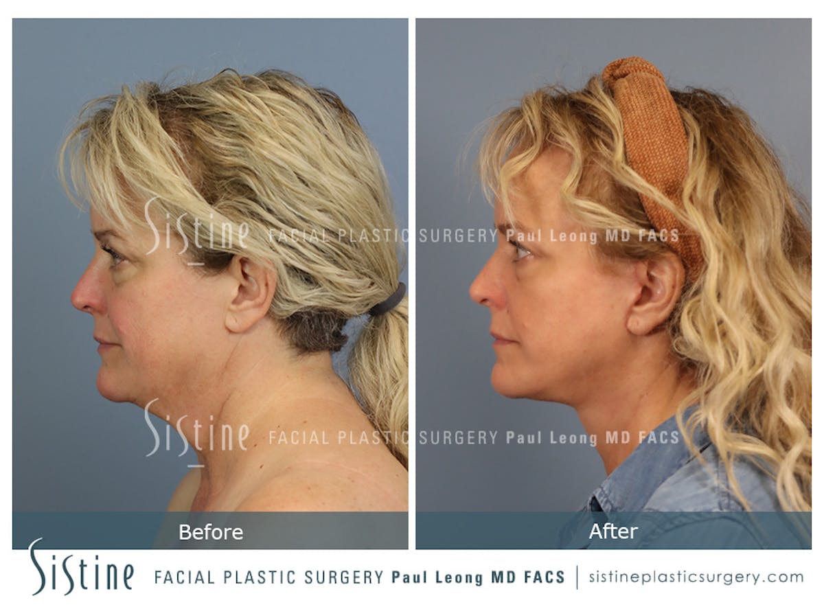 Facelift Before & After Gallery - Patient 302623 - Image 7