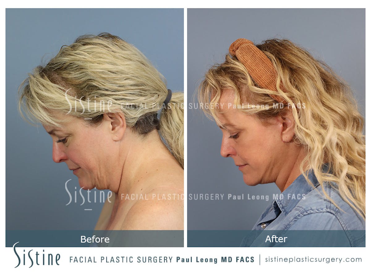 Facelift Before & After Gallery - Patient 302623 - Image 8