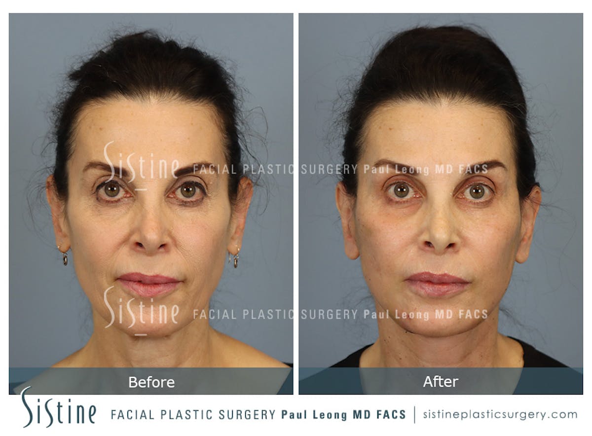 Facelift Before & After Gallery - Patient 279304 - Image 1
