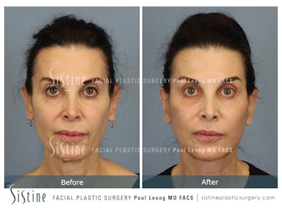 Facelift Before & After Gallery - Patient 279304 - Image 1