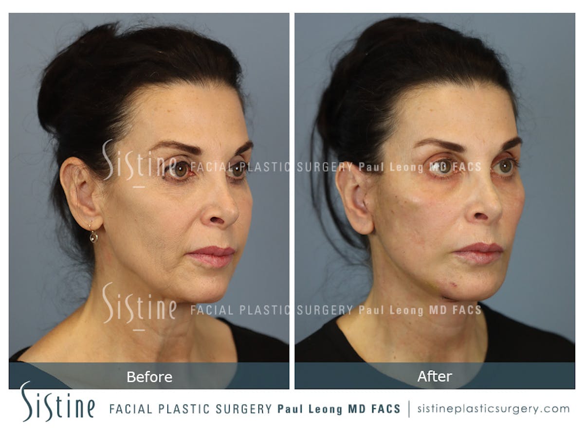 Facelift Before & After Gallery - Patient 279304 - Image 2