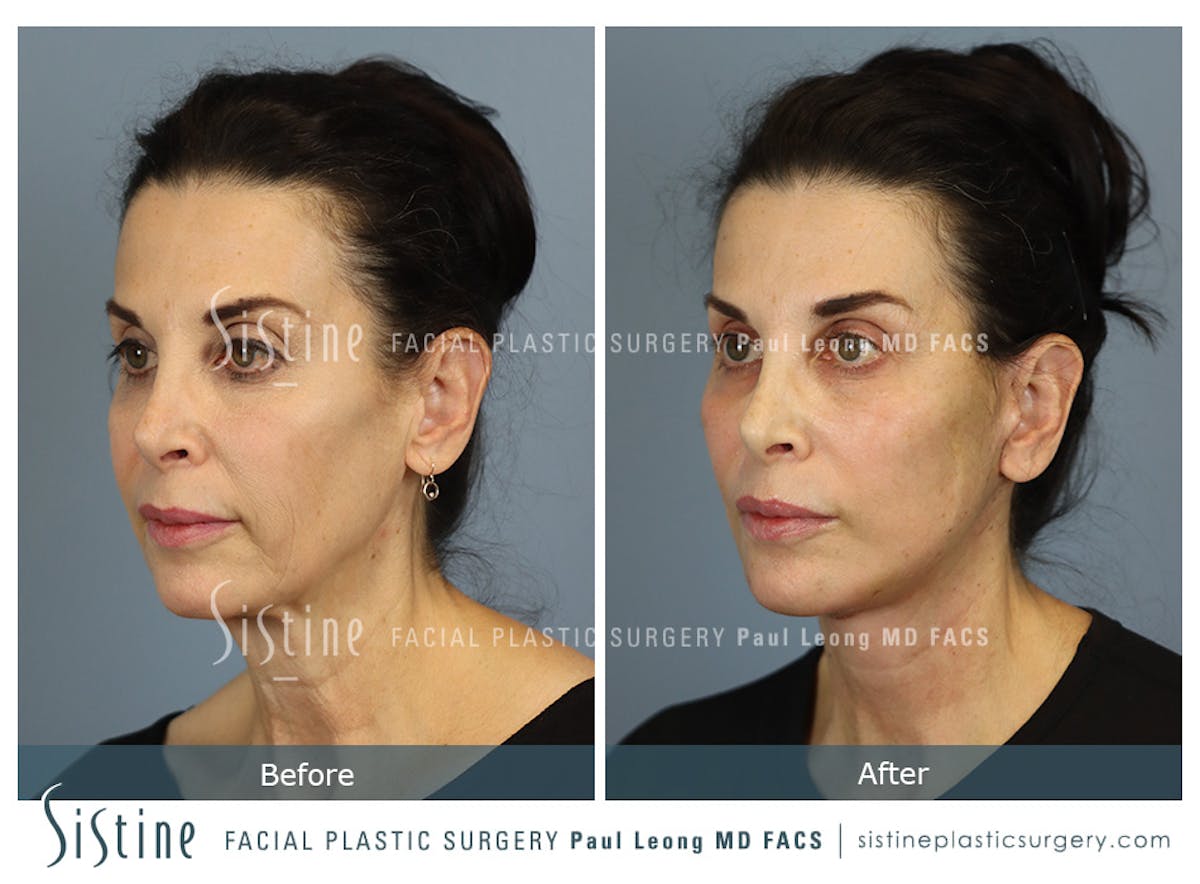 Facelift Before & After Gallery - Patient 279304 - Image 3
