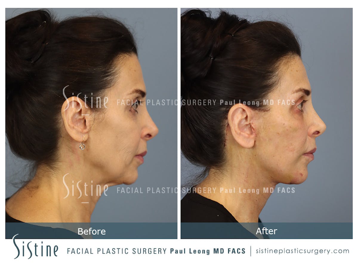 Facelift Before & After Gallery - Patient 279304 - Image 4