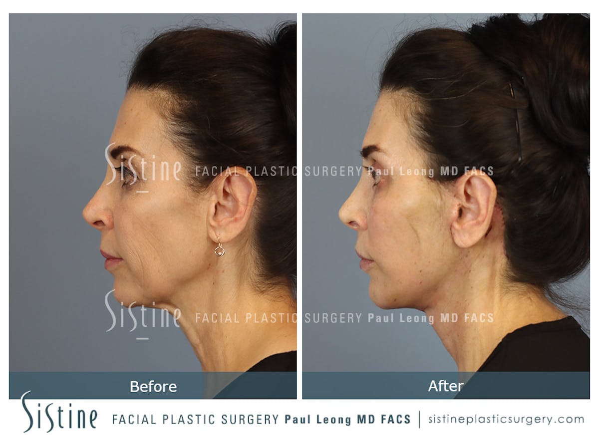Facelift Before & After Gallery - Patient 279304 - Image 5