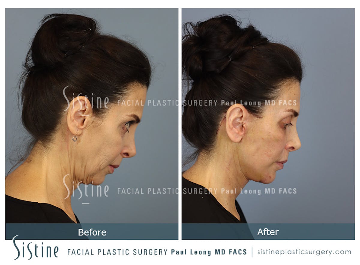 Facelift Before & After Gallery - Patient 279304 - Image 6