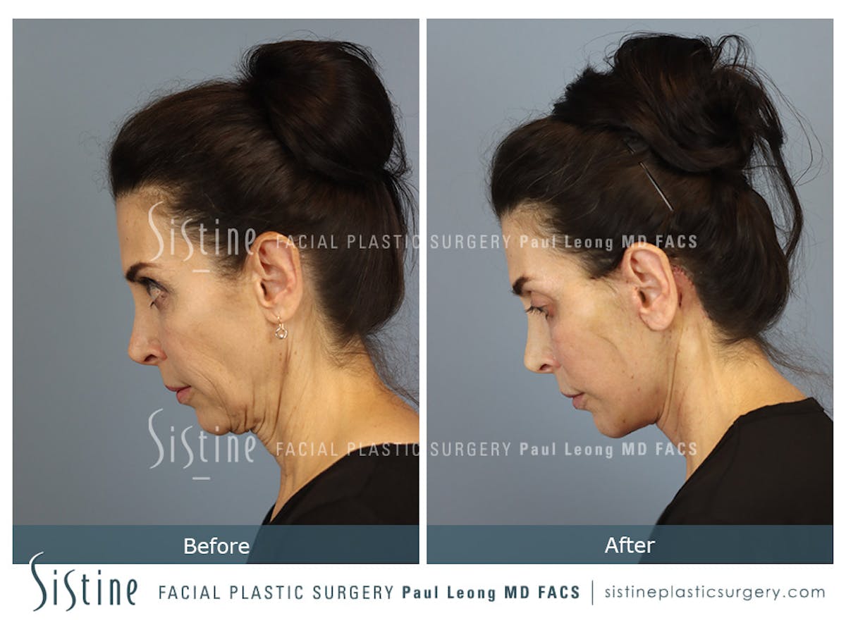 Facelift Before & After Gallery - Patient 279304 - Image 7